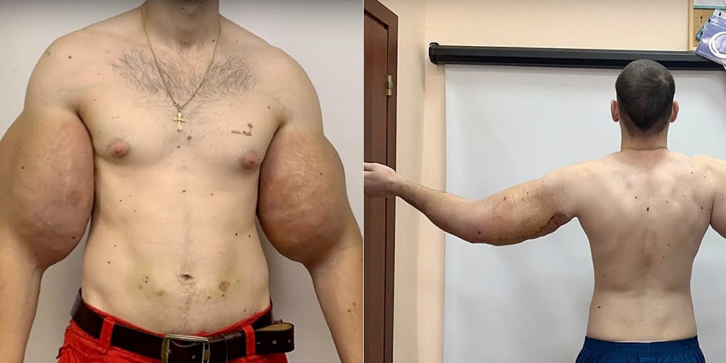 The Journey To Become A Synthol Man-What No One Told You